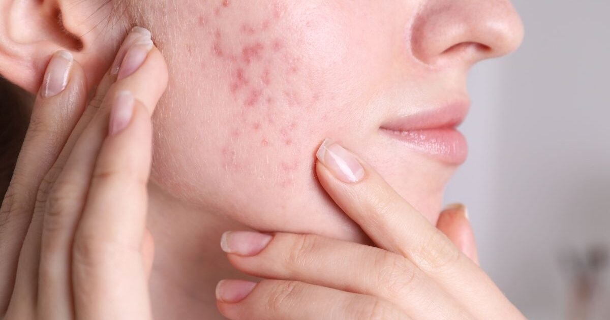 Os Melhores Sabonetes Faciais para Pele Acneica