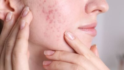 Os Melhores Sabonetes Faciais para Pele Acneica