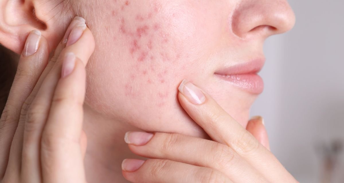 Os Melhores Sabonetes Faciais para Pele Acneica