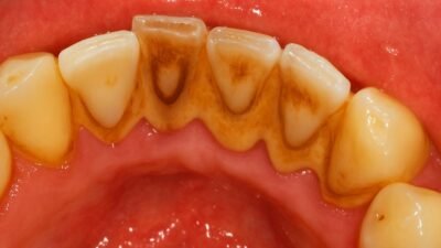 Como Deixar os Dentes Brancos e Prevenir o Tártaro
