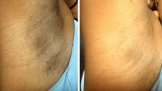 Clareador de Manchas Com resultados Surpreendentes