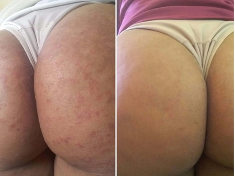 Foliculite ou Manchas no Bumbum