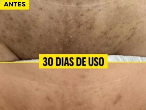 Virilhas Escura ou Pós Depilação